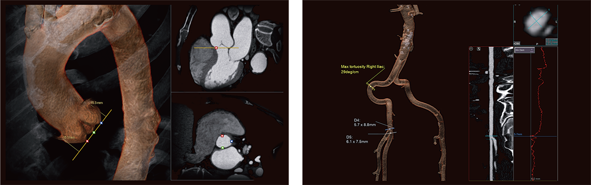 Structural heart disease