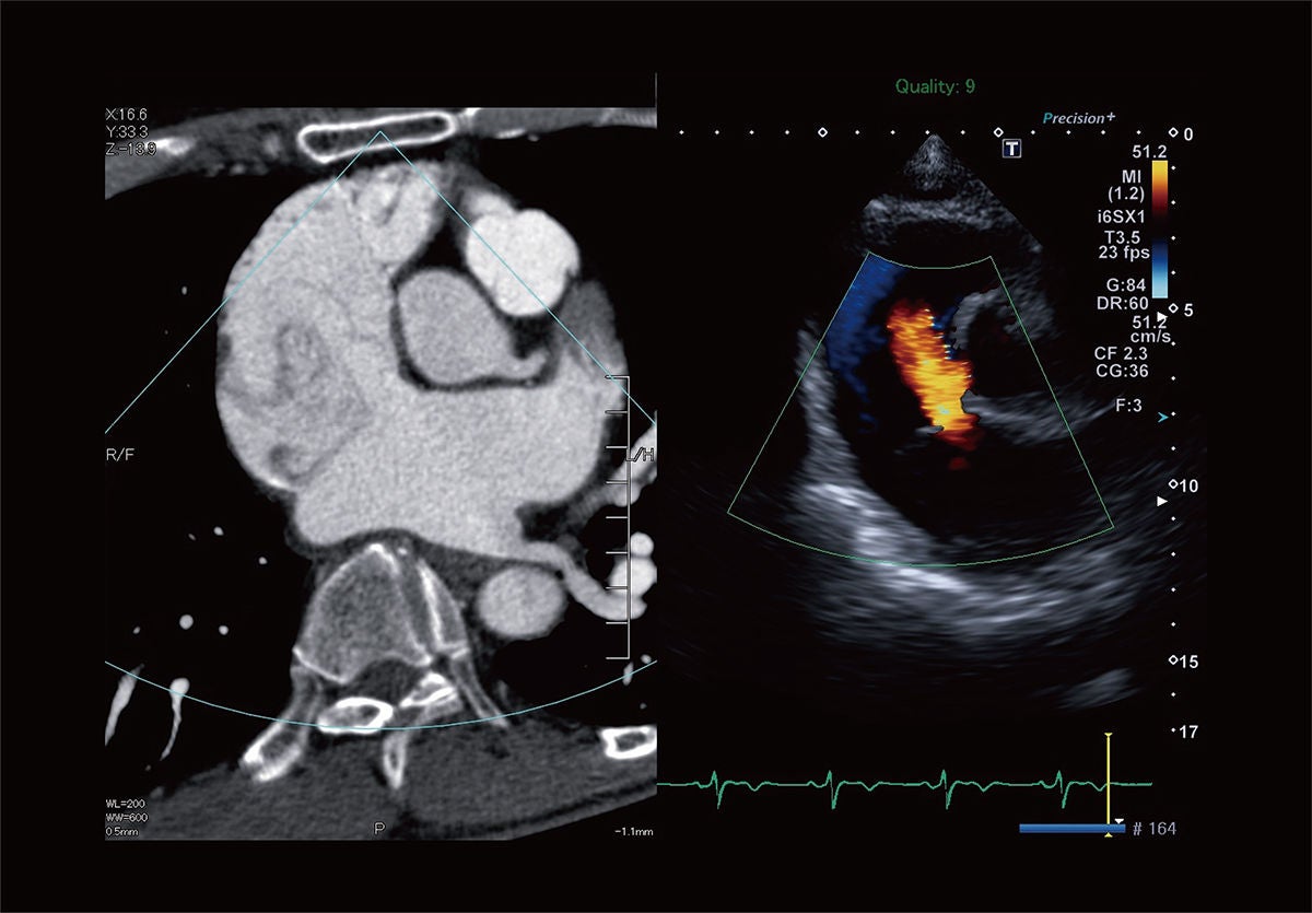 Congenital heart disease