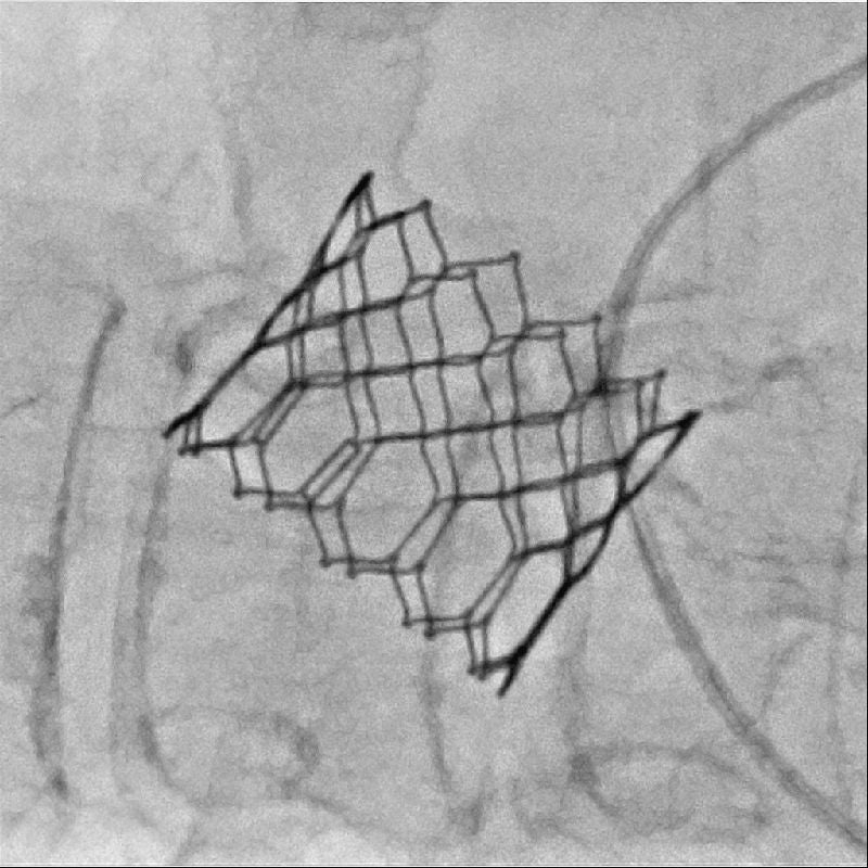 Congenital heart disease