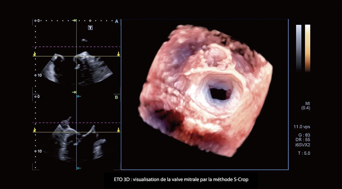 Structural heart disease