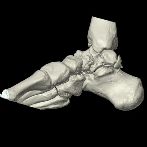 Ankle TDM