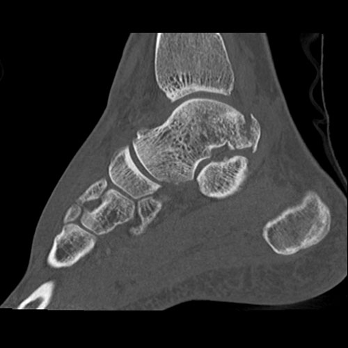 Ankle TDM