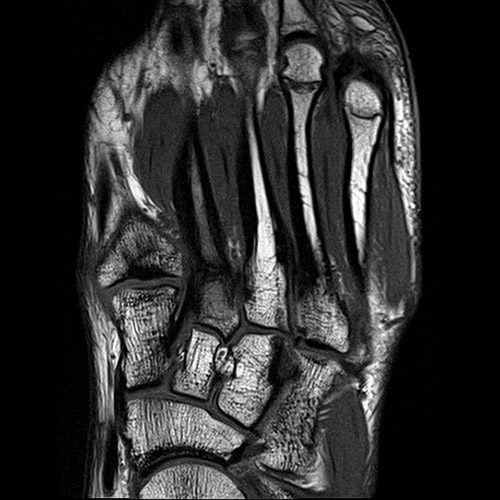Foot IRM // Fracture osseuse