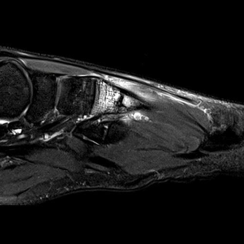 Foot IRM // Fracture osseuse