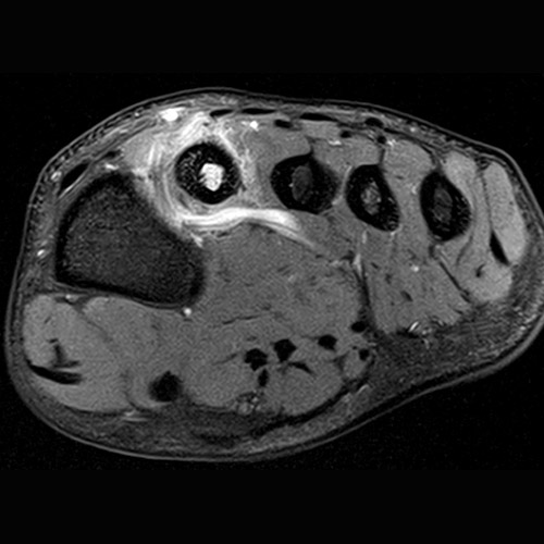Foot IRM // Fracture osseuse