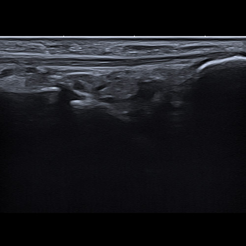 Foot Échographie // Tendon du muscle court fibulaire