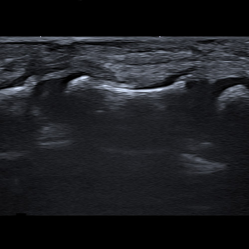 Hand Échographie // Nerf de la main d’un patient pédiatrique