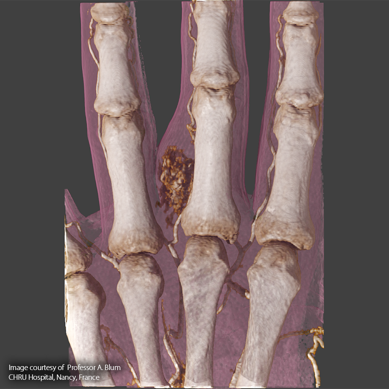 Hand TDM // Malformation vasculaire