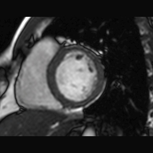 Heart IRM 1