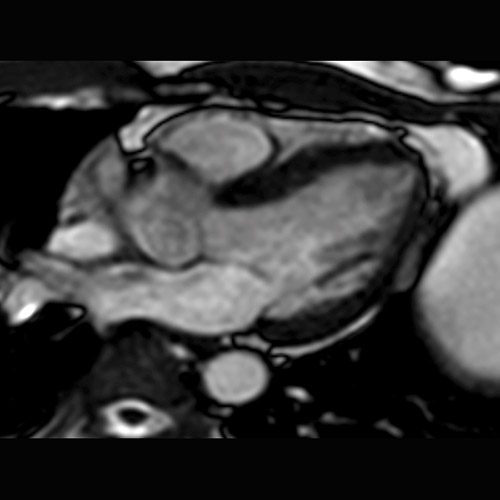Heart IRM 2