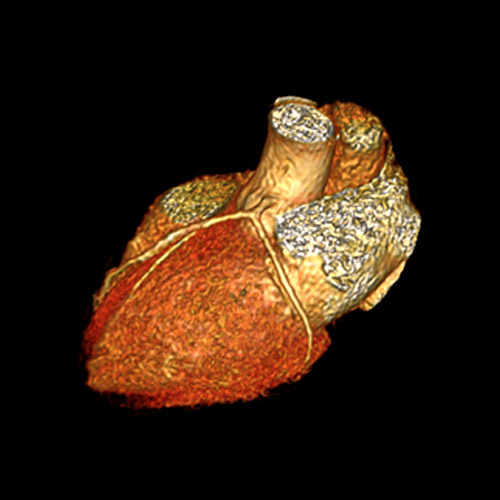 Heart IRM 4