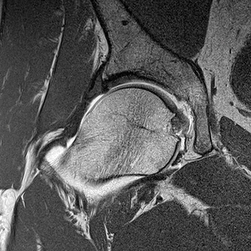 Hip IRM // Arthrographie de la hanche
