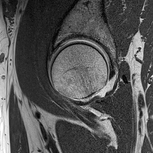 Hip IRM // Arthrographie de la hanche