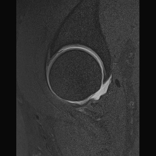 Hip IRM // Arthrographie de la hanche