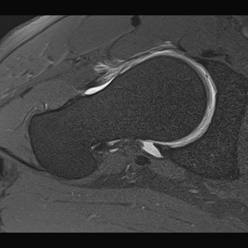 Hip IRM // Arthrographie de la hanche