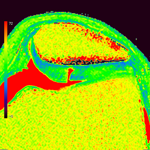 Knee IRM 1
