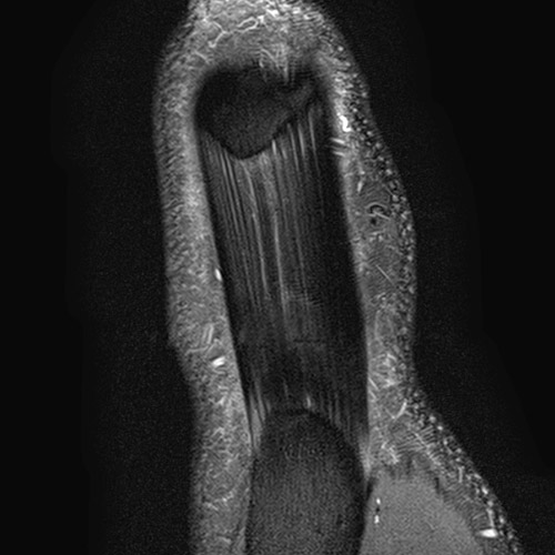 Knee IRM // Tendon rotulien 1