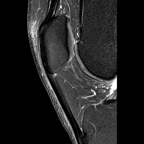 Knee IRM // Tendon rotulien 2
