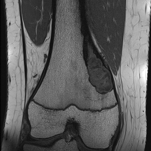 Knee IRM // Tumeur osseuse
