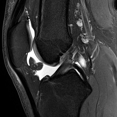 Knee IRM 2