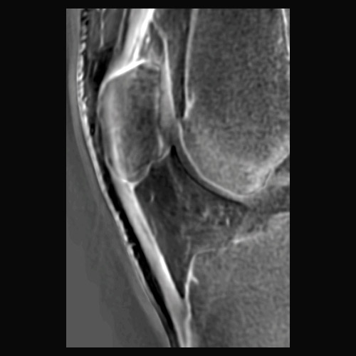 Knee IRM // Tendon rotulien 2