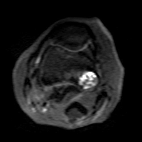 Knee IRM // Tumeur osseuse