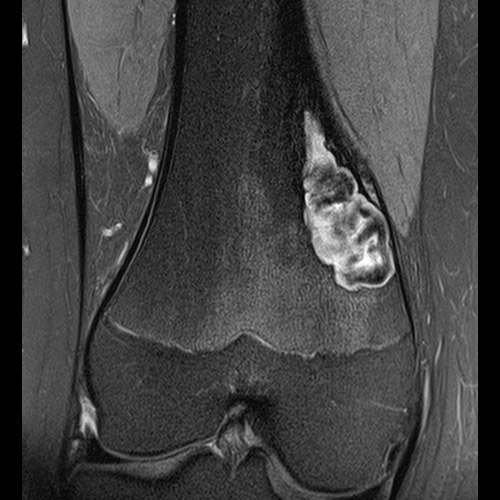 Knee IRM // Tumeur osseuse