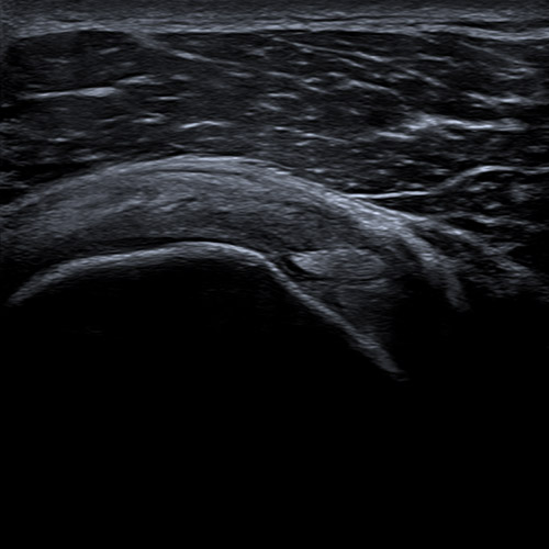 Aplio i800 Écographie // Tendon sus-épineux 2