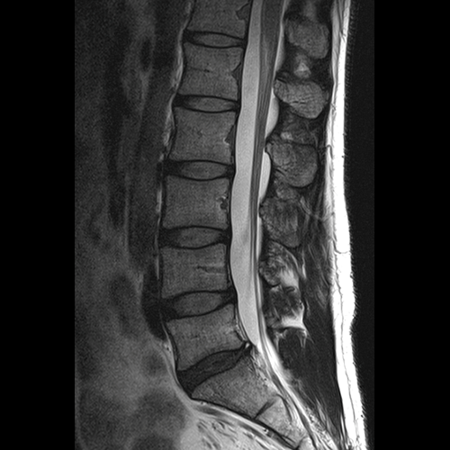 Spine IRM // Colonne lombaire