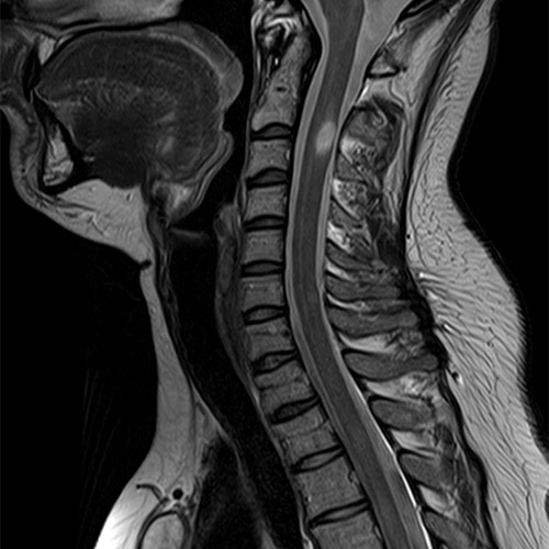 Spine IRM // Colonne cervicale 1