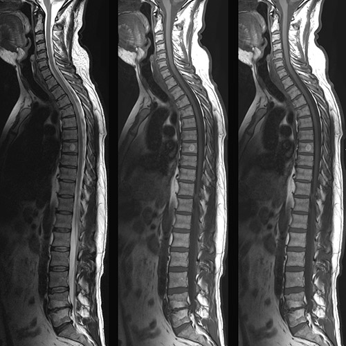 Spine IRM // Colonne entière