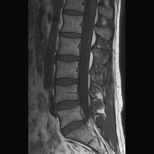 Spine IRM // Colonne lombaire