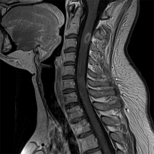 Spine IRM // Colonne cervicale 1
