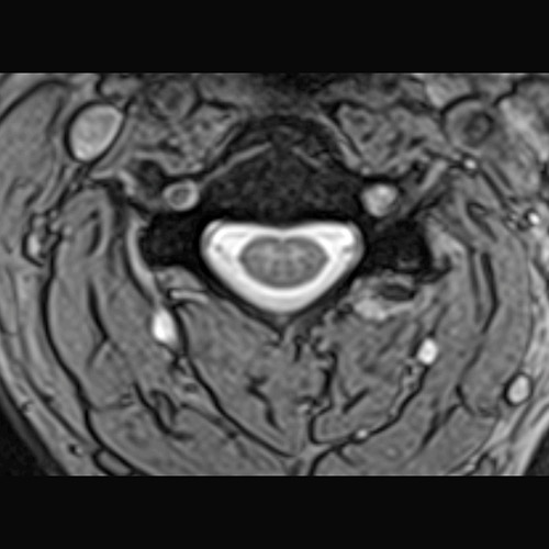 Spine IRM // Colonne cervicale 2