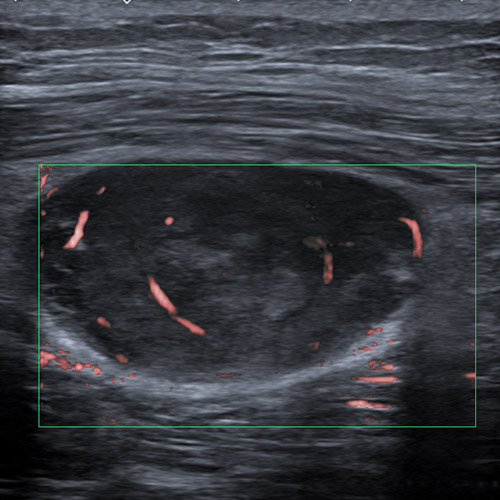 Thigh Échographie // Lésion fusocellulaire 1