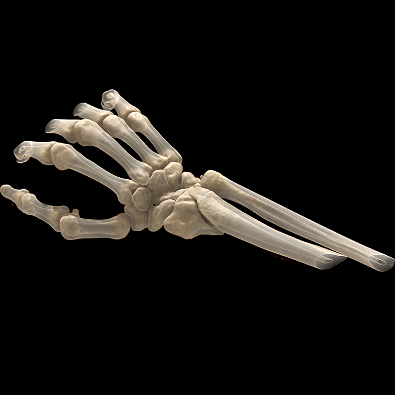Wrist TDM // Fracture de Pouteau-Colles