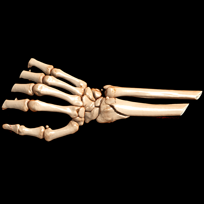 Wrist TDM // Fracture de Pouteau-Colles