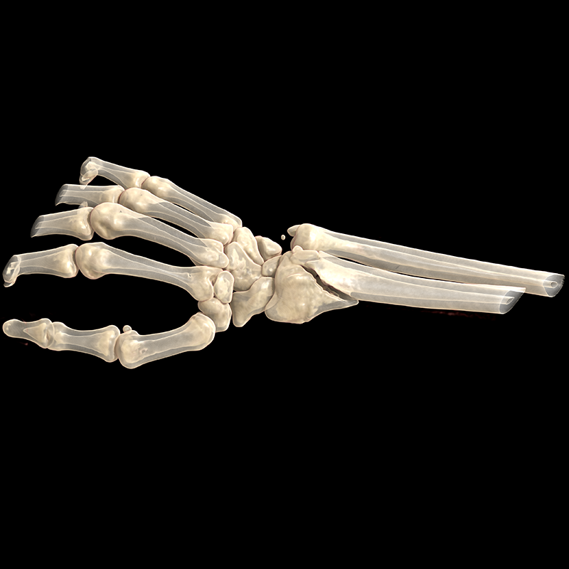 Wrist TDM // Fracture de Pouteau-Colles