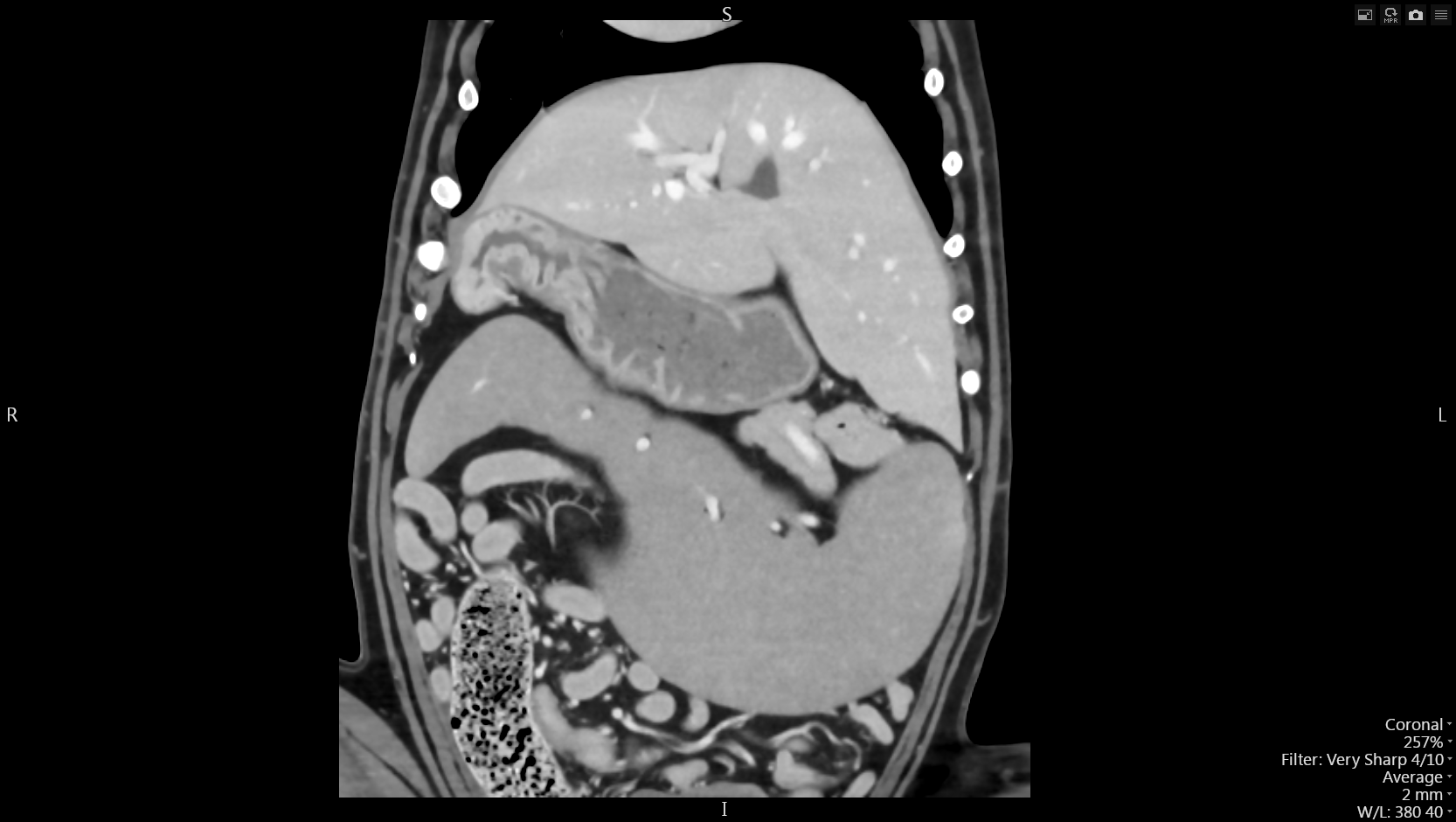 Body Thorax - TDM