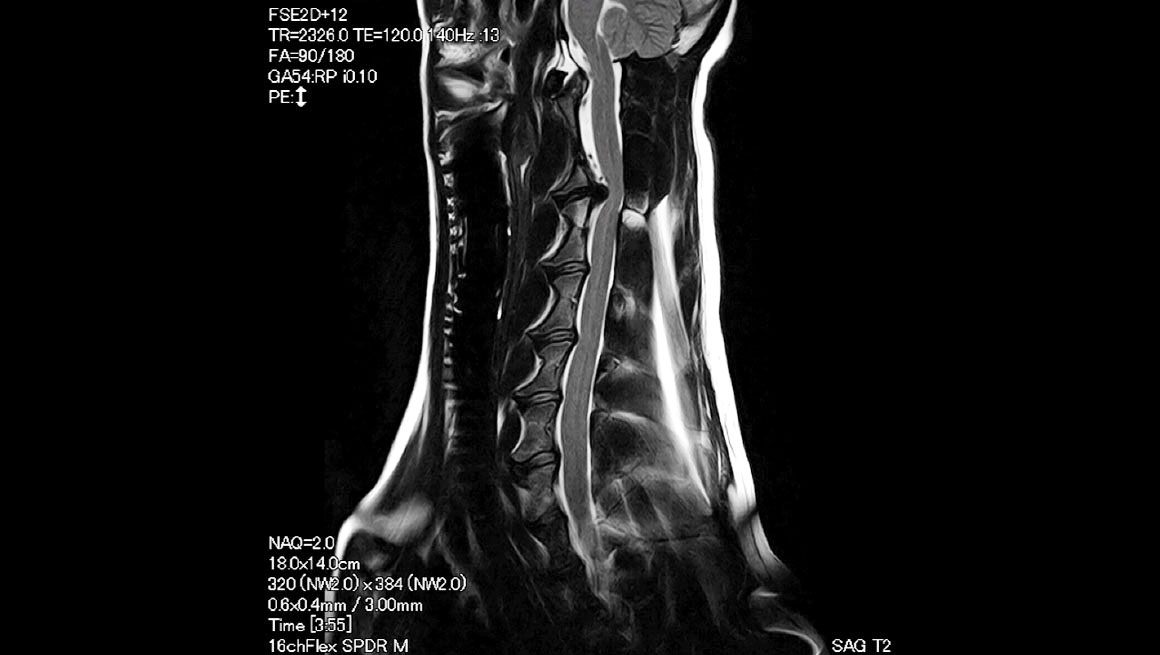 Body Colonne cervicale du chien - IRM