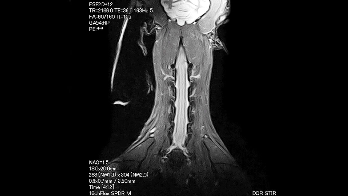 Body Colonne cervicale du chien - IRM
