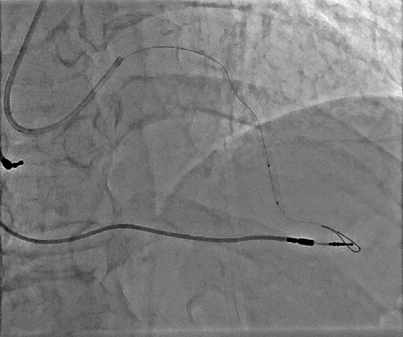 Cardiology PCI