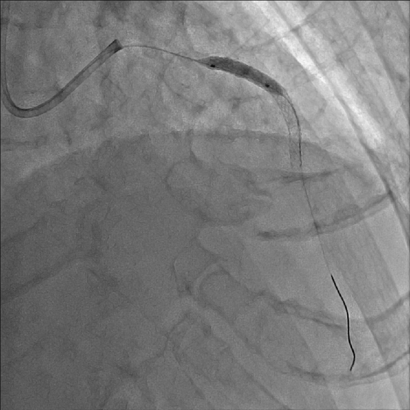 Cardiology PCI