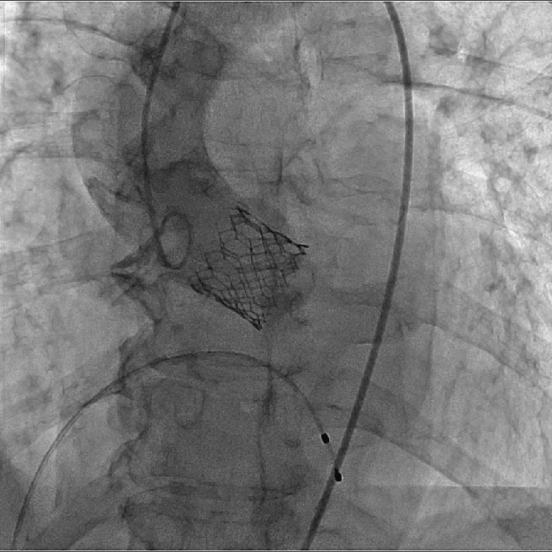 Cardiology Interventions en SHD