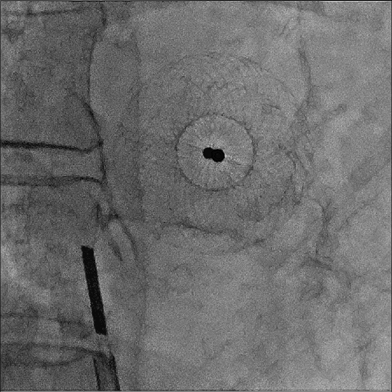 Cardiology Interventions en SHD
