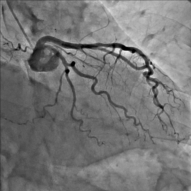 Cardiology Coronarographie
