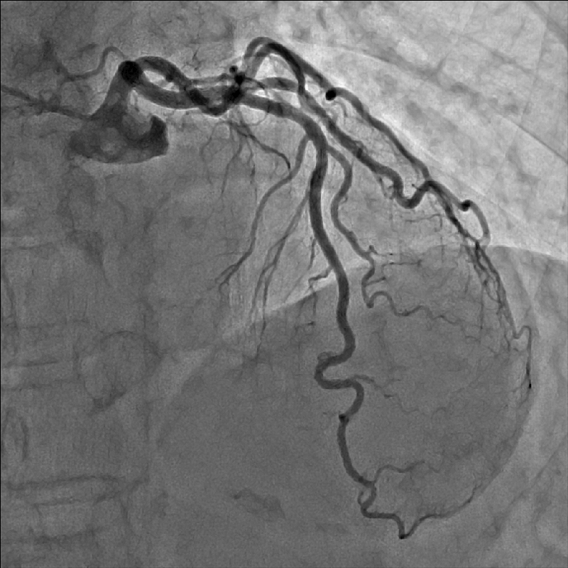 Cardiology Coronarographie