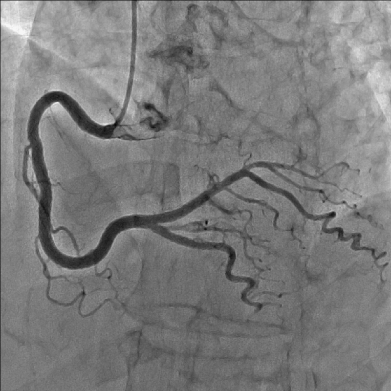 Cardiology Coronarographie