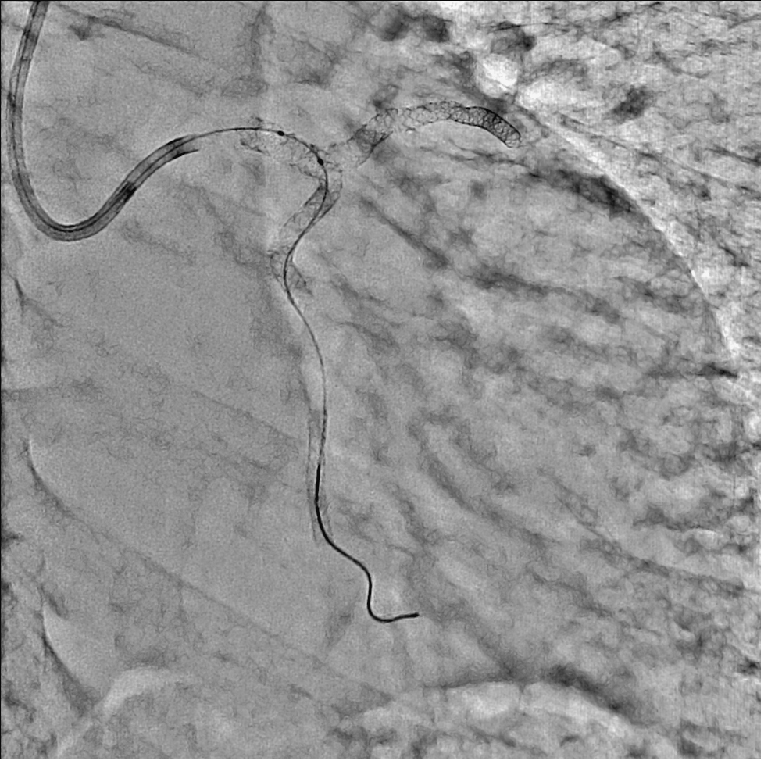 Cardiology PCI