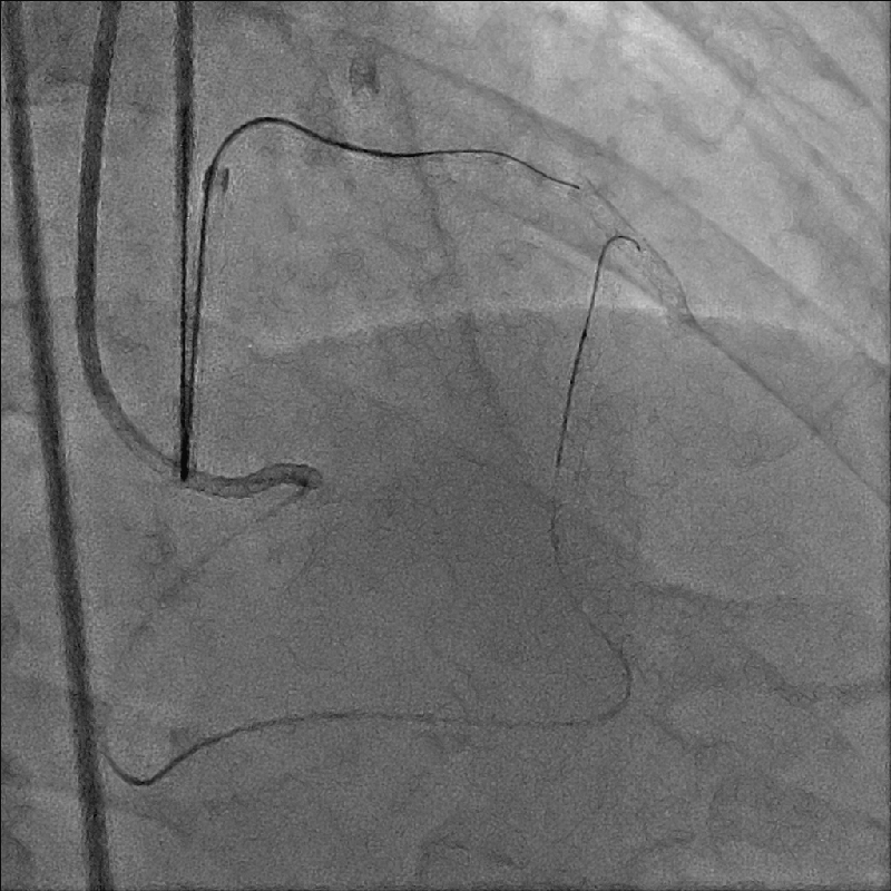 Cardiology PCI